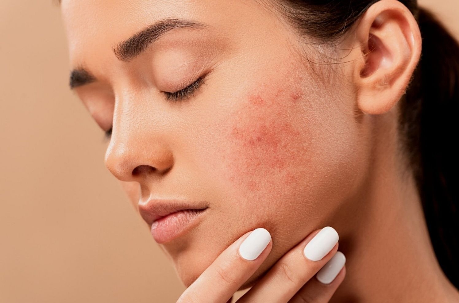 humidifier for acne