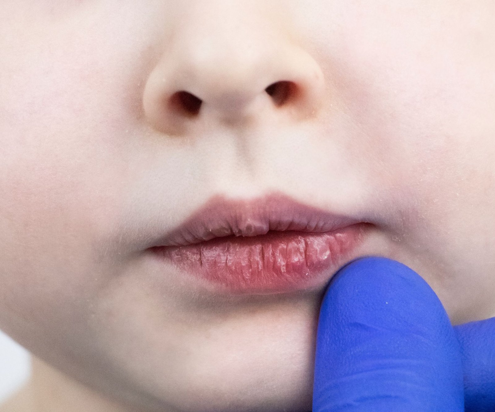 Can a Humidifier Help With Dry Mouth